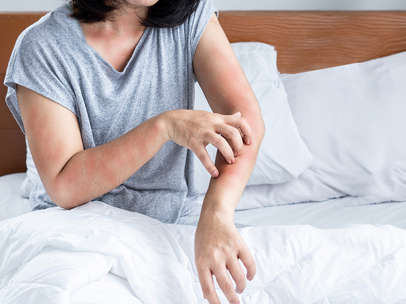 the girl is lying in bed with an allergic reaction, itching on her body and redness