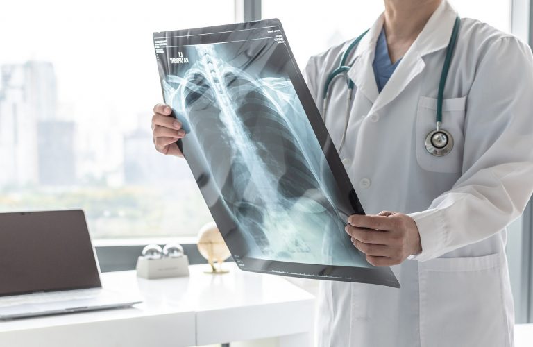 Doctor with radiological chest x-ray film for medical diagnosis on patient’s health on asthma, lung disease and bone cancer illness, healthcare hospital service concept