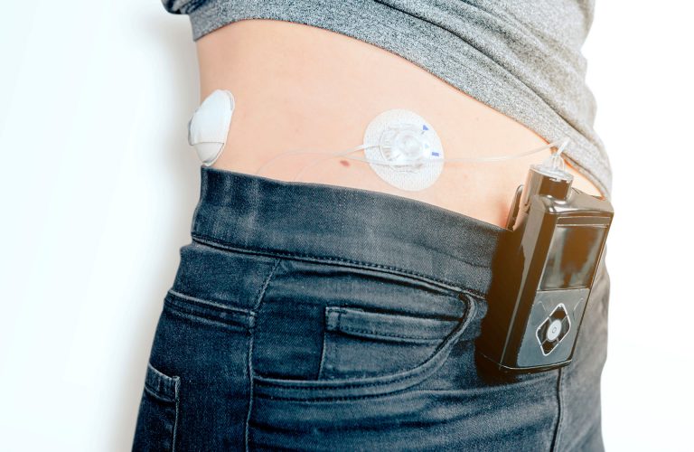 close up of a female diabetic patient with infusion insulin pump connected on the belly - medical device with wireless transmission technology - health care concept
